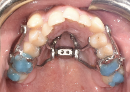 Custom MARPE appliance